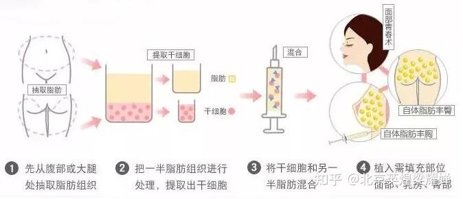 关于最佳自体脂肪隆胸医院的探索