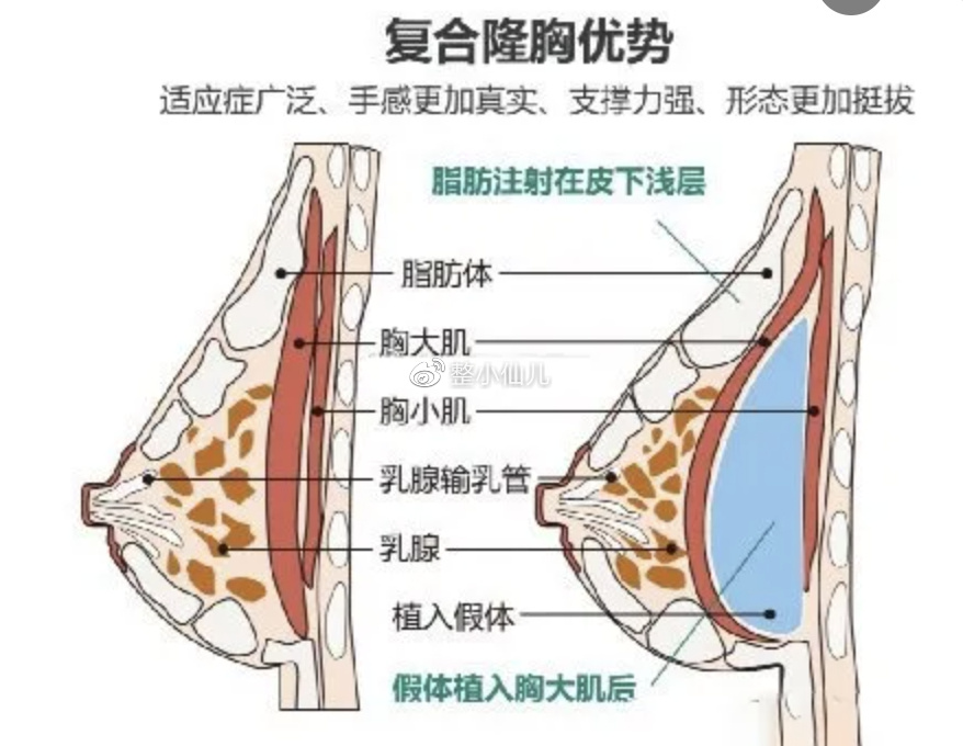 丰胸整形术，探索与理解