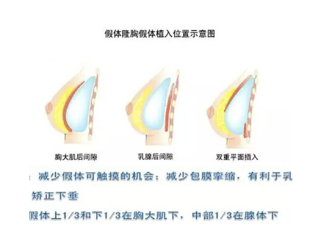 探索最佳隆胸医院，专业与信誉并重