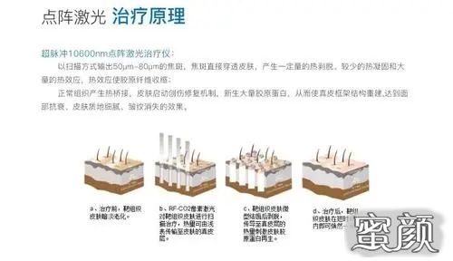 激光美白价格，全面解析与选择指南