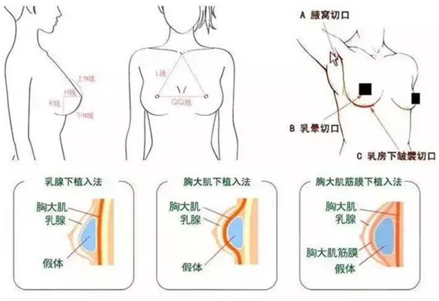 隆胸图片，理解并尊重个人选择