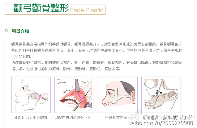 颧骨颧弓整形的探索与实践