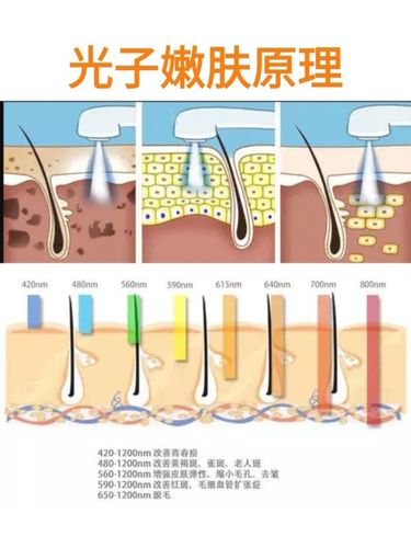 激光光子嫩肤价格，深入了解与全面解析