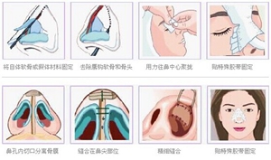 鼻头整形费用详解，价格因素、手术类型与注意事项