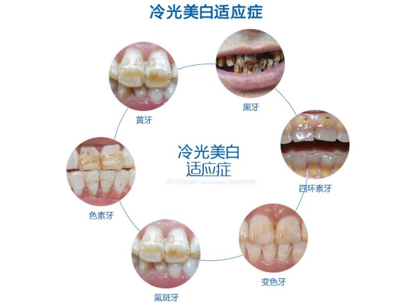 彩光美白牙齿，价格与选择的重要性