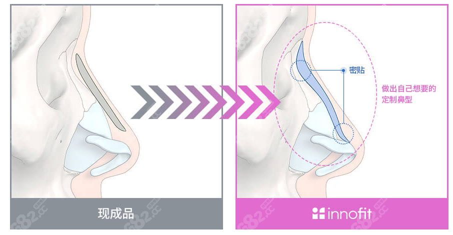 假体隆鼻的费用详解