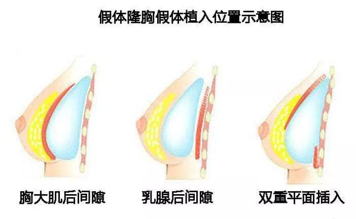 琴面假体隆胸，现代女性追求美的艺术之旅