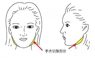 下颌角整形的艺术重塑与审美考量