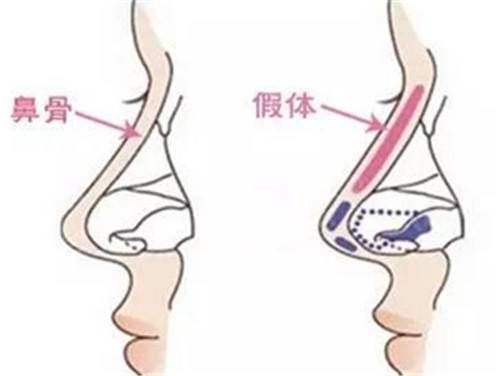 假体隆鼻手术价格，全面解析与深度探讨