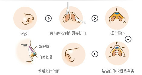 自体软骨隆鼻手术整形，重塑完美鼻型的艺术之旅