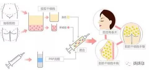 水动力吸脂，革新性技术在美容领域的应用与前景