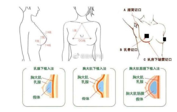 假体隆胸的价位，全面解析费用因素与选择策略