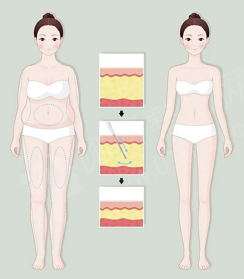 揭秘360吸脂技术，瘦身塑形的新选择