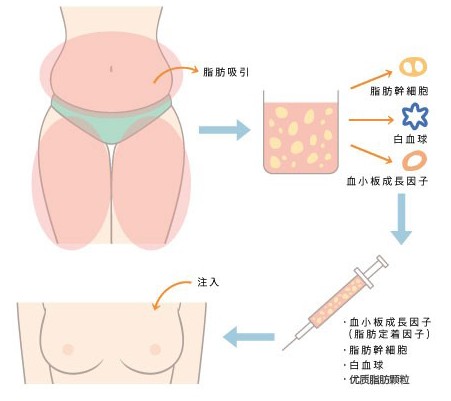 全面解析吸脂手术费用及其相关因素