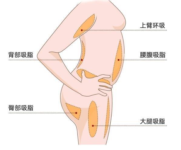 吸脂减肥的价格因素与费用概述