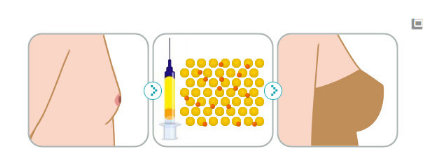 自体脂肪隆胸术，探索与理解