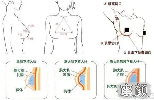 妙桃假体价格，深入了解与全面解析