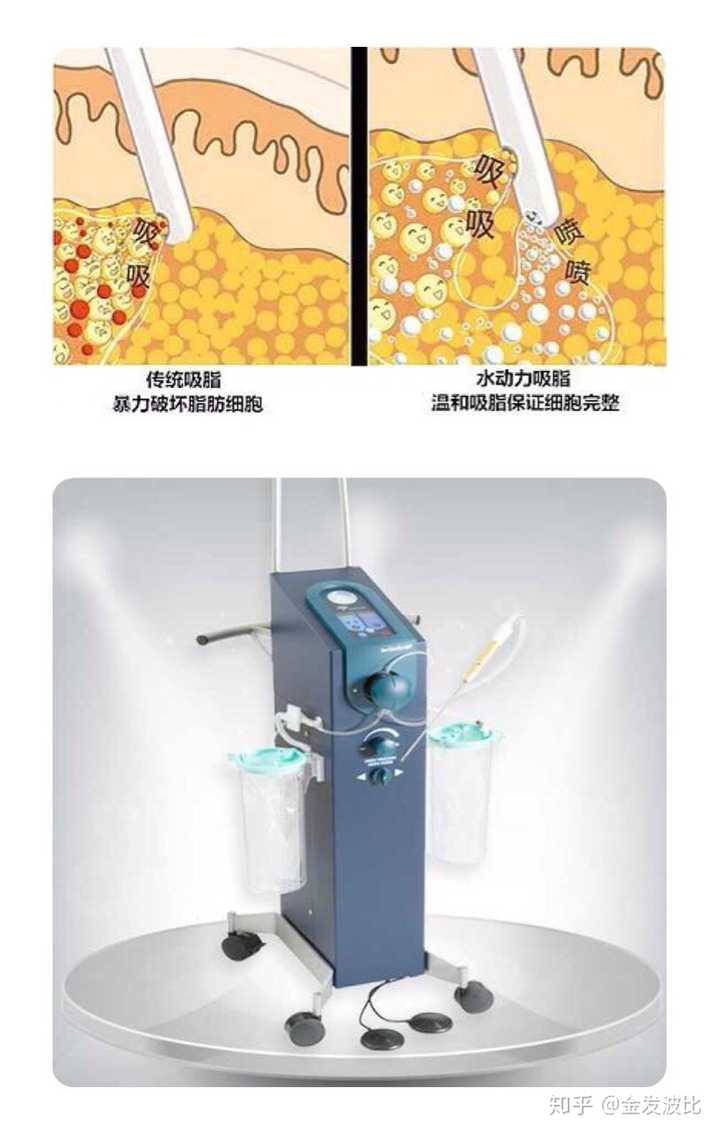 激光溶脂价格解析，因素、成本与效益