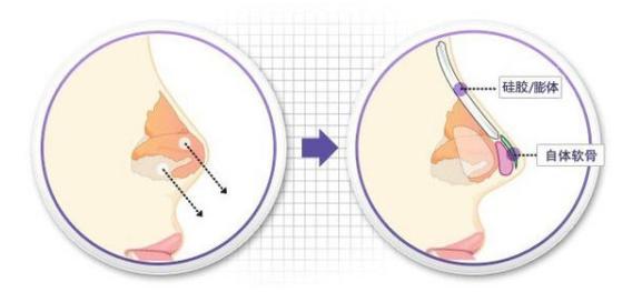 自体脂肪隆鼻，价格与考虑因素详解