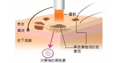 激光祛痘印痘疤，重塑肌肤的神奇之旅