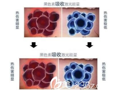 激光嫩肤要多少钱，全面解析费用因素与选择策略