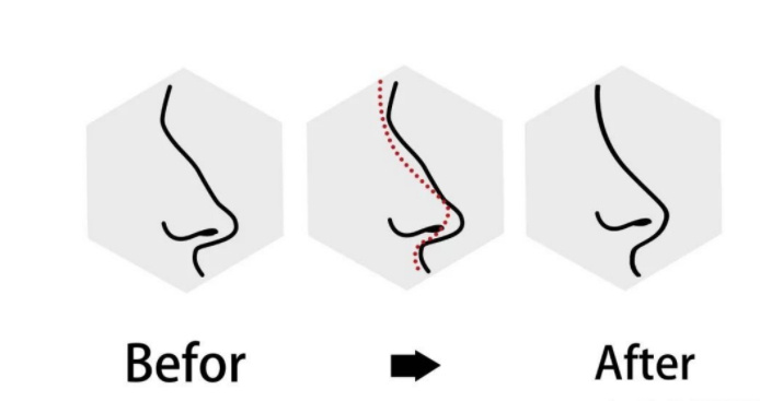 重塑自信之美，关于隆鼻修复的探索