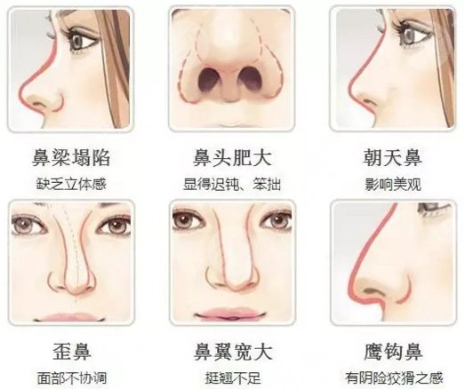 鼻尖整形手术价格详解，因素、费用及注意事项