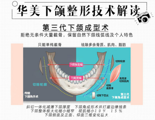 关于去咬肌价格的探讨